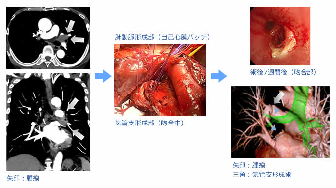 気管支・肺動脈形成術