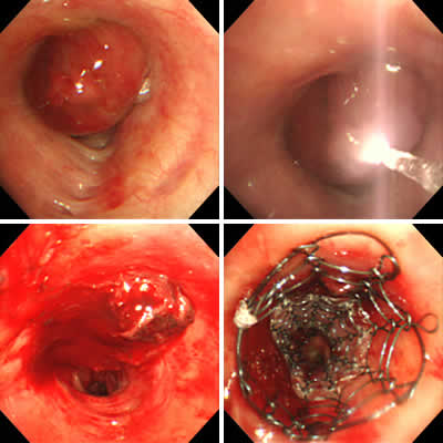 気道にステント留置を行う様子