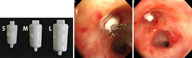 難治性気胸に対して気管支充填剤を用いて、気管支にフタをする様子