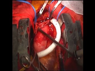 上大静脈合併切除および自己心膜による再建術の様子