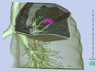 画像解析ソフトで確認できる病巣