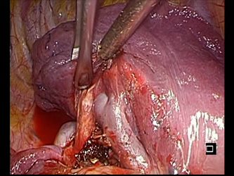 肺区域切除術の様子
