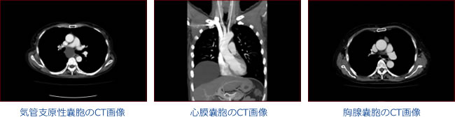 先天性嚢胞のCT画像