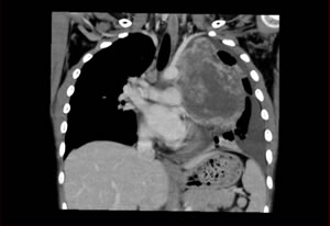 卵黄嚢がんのCT画像