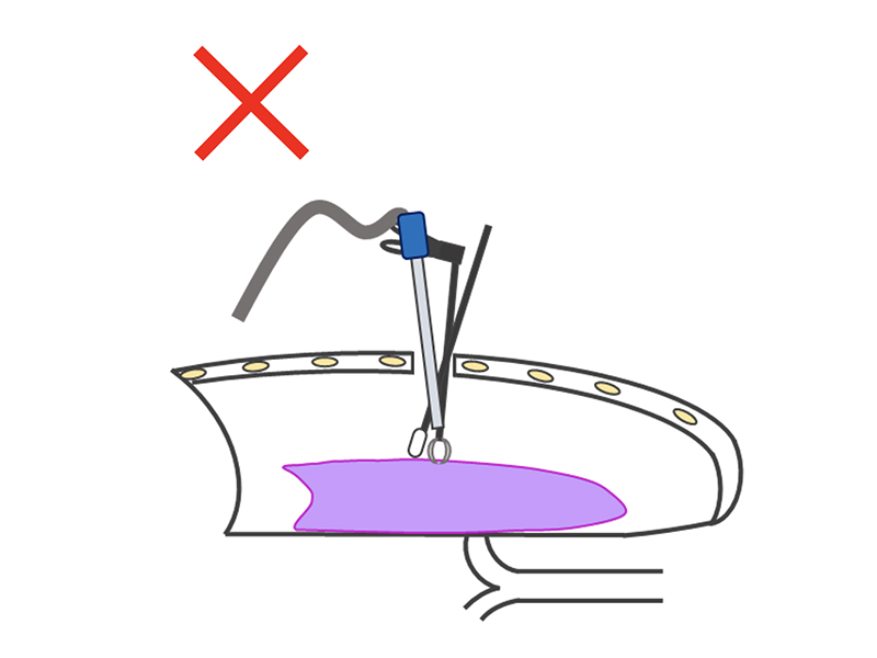胸腔鏡手術（単孔式）の良くない例の説明イラスト