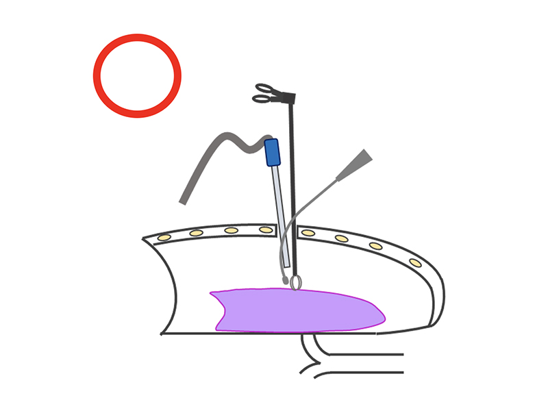 胸腔鏡手術（単孔式）の良い例の説明イラスト
