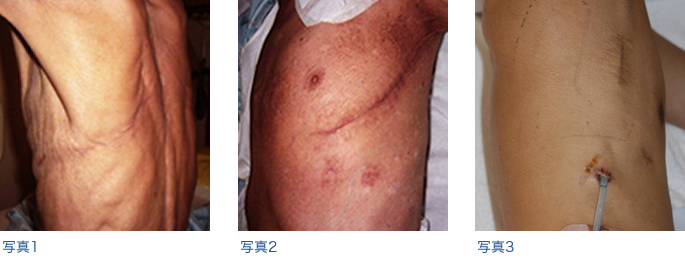 肺がんに対する胸腔鏡下手術