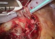 完全鏡視下手術の風景