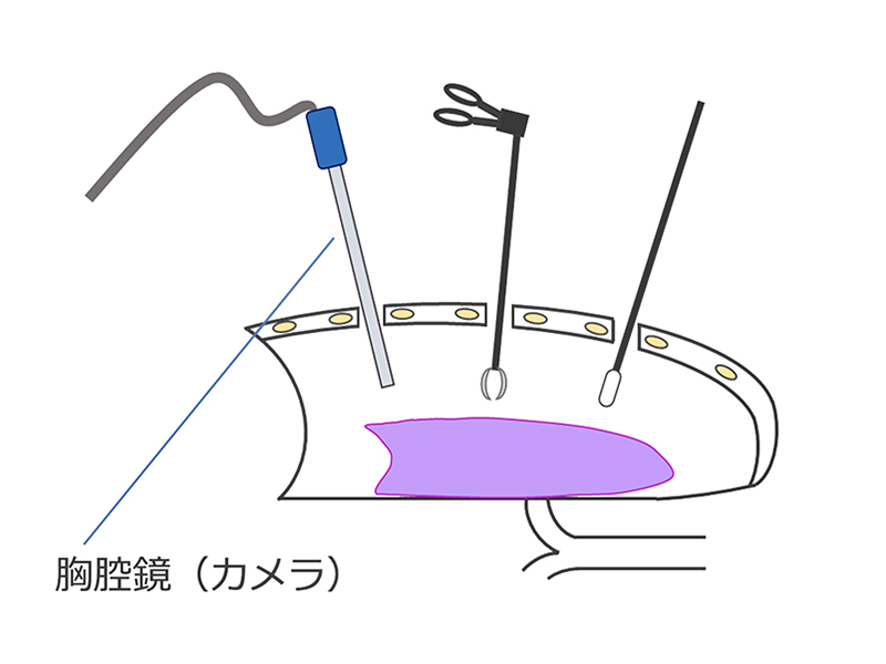 胸腔鏡手術（多孔式）の説明イラスト