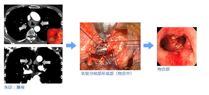 気管分岐部形成術